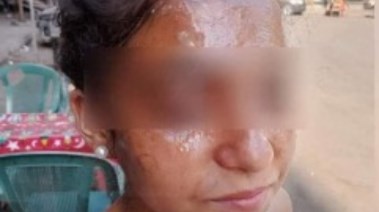 الطالبة كارولين ضحية سكب مياه ساخنة على وجهها في مدرسة بفيصل