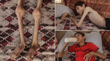 شاب فلسطيني يعاني من سوء التغذية الحاد 