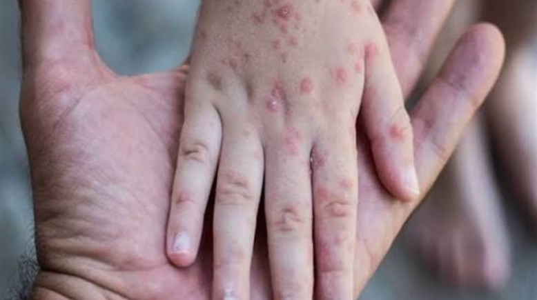 الجدري المائي