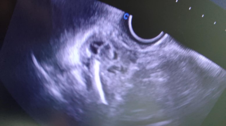 سونار ثقب اللولب لرحم شيماء عيسى