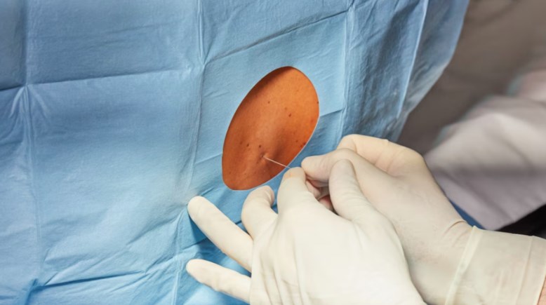 حقن أسفل الظهر