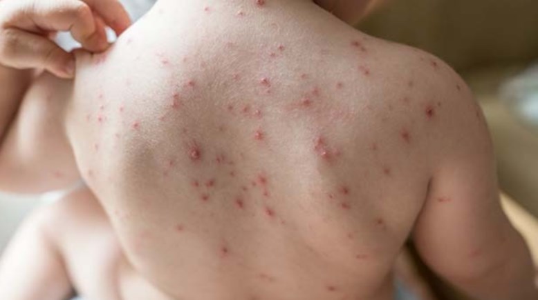 الجدري المائي الجدري المائي