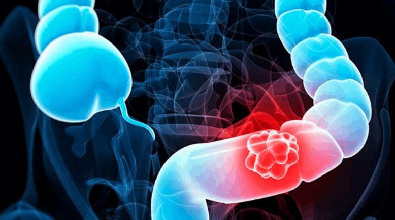 الأمعاء-تعبيرية