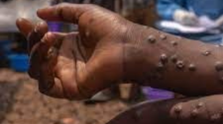 جدري القرود جدري القرود