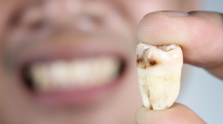 تفسير حلم تسوس الأسنان في المنام