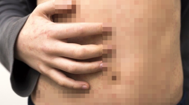 وباء الحصبة 