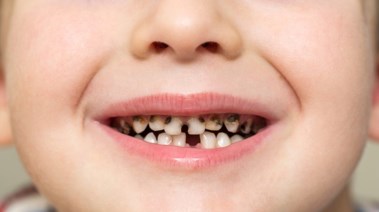 تسوس الأسنان تسوس الأسنان