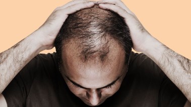 تساقط الشعر لدى الرجال