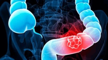 الأمعاء-تعبيرية الأمعاء-تعبيرية