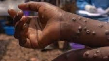 جدري القرود جدري القرود