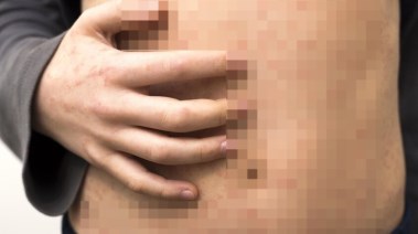 وباء الحصبة  وباء الحصبة