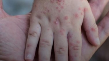 أعراض مرض الجدري المائي أعراض مرض الجدري المائي