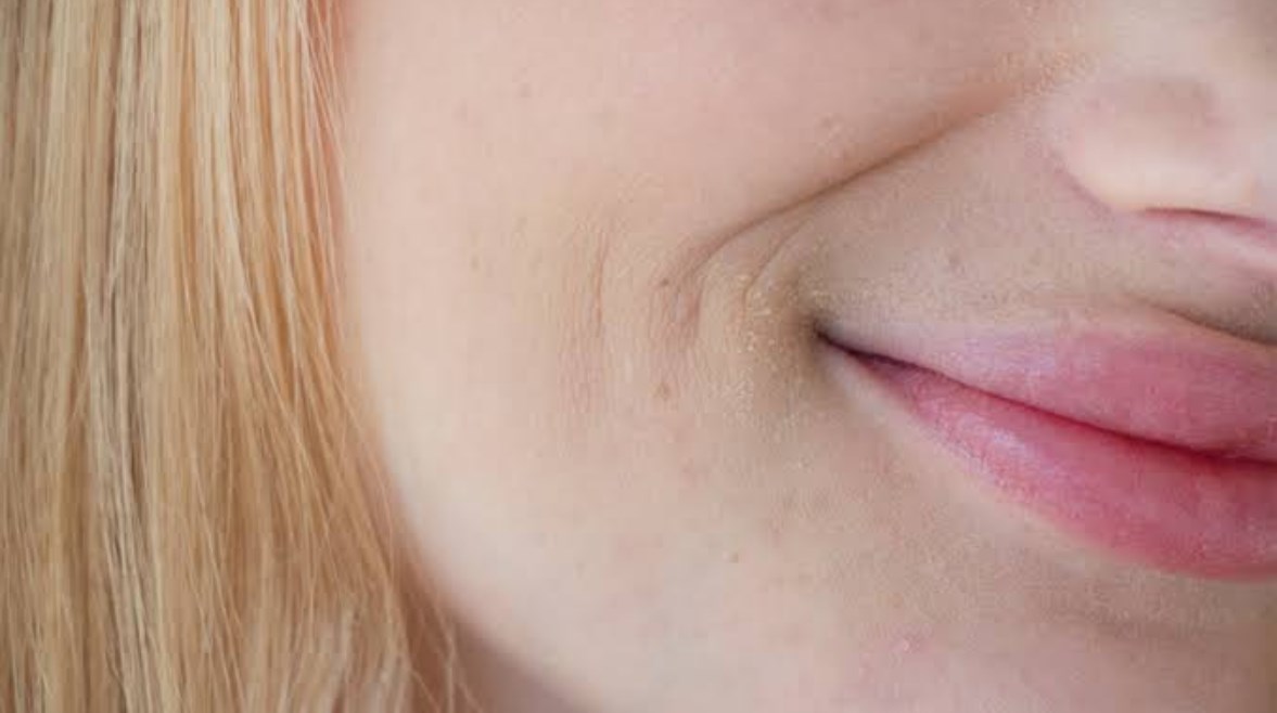 الاسمرار حول الفم الاسمرار حول الفم