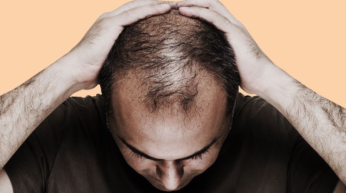 تساقط الشعر لدى الرجال