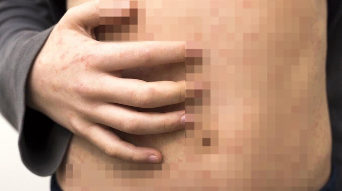 وباء الحصبة وباء الحصبة
