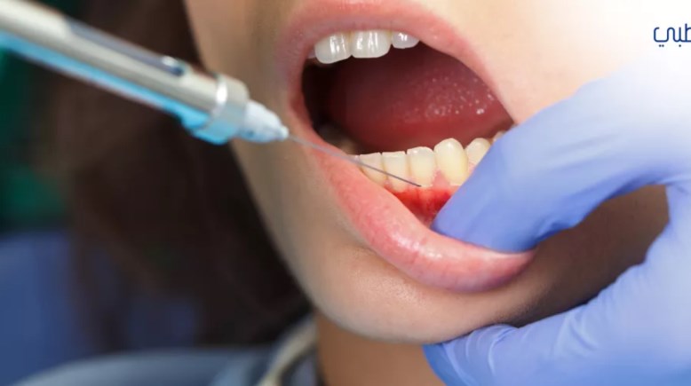 بنج الأسنان