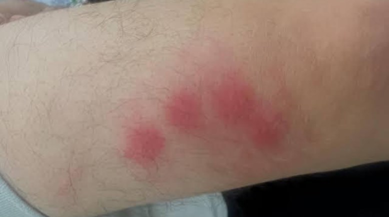 أثر لدغات حشرة البق على أجساد التلاميذ