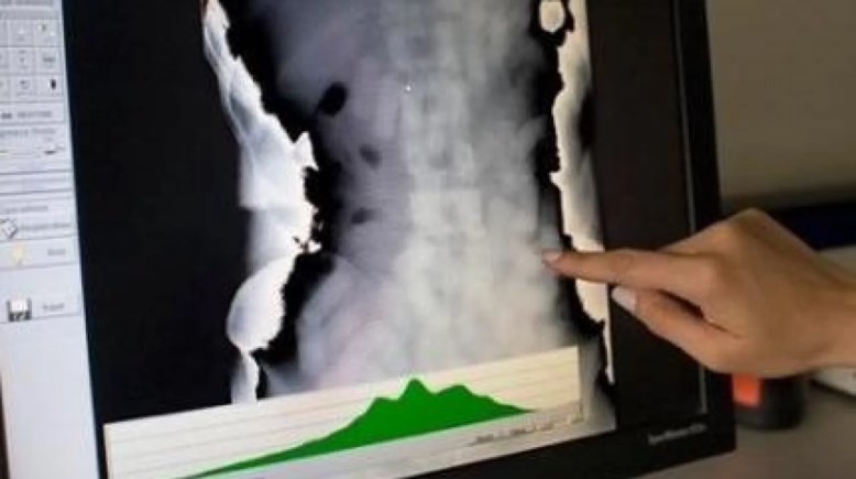 الكوكايين داخل أمعاء أحد المهربين في مطار فرانكفورت 2017