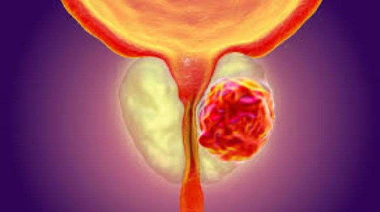 سرطان البروستاتا