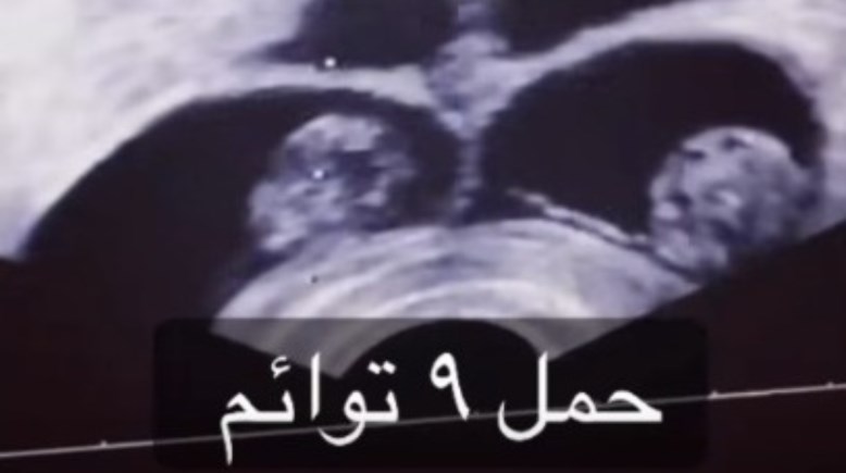 الموجات الفوق صوتية لسيدة حامل بـ 9 أجنة