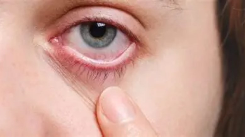 مرض  التراكوما 