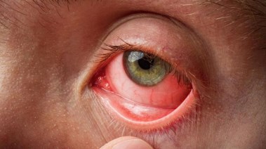 تعبيرية عن عمليات الرمد والمياة البيضاء