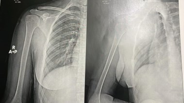 الأشعة الطبية للفتاة