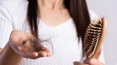 تساقط الشعر - أرشيفية