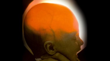 طفلة بدون مخ- تعبيرية