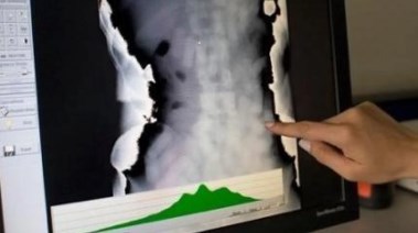 الكوكايين داخل أمعاء أحد المهربين في مطار فرانكفورت 2017