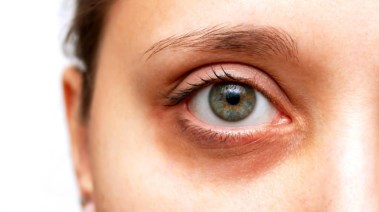 الهالات السوداء