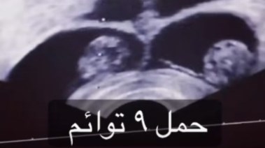 الموجات الفوق صوتية لسيدة حامل بـ 9 أجنة