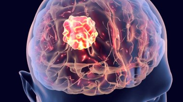 أورام الدماغ