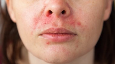  التهاب الجلد حول الفم