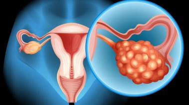 سرطان المبيض