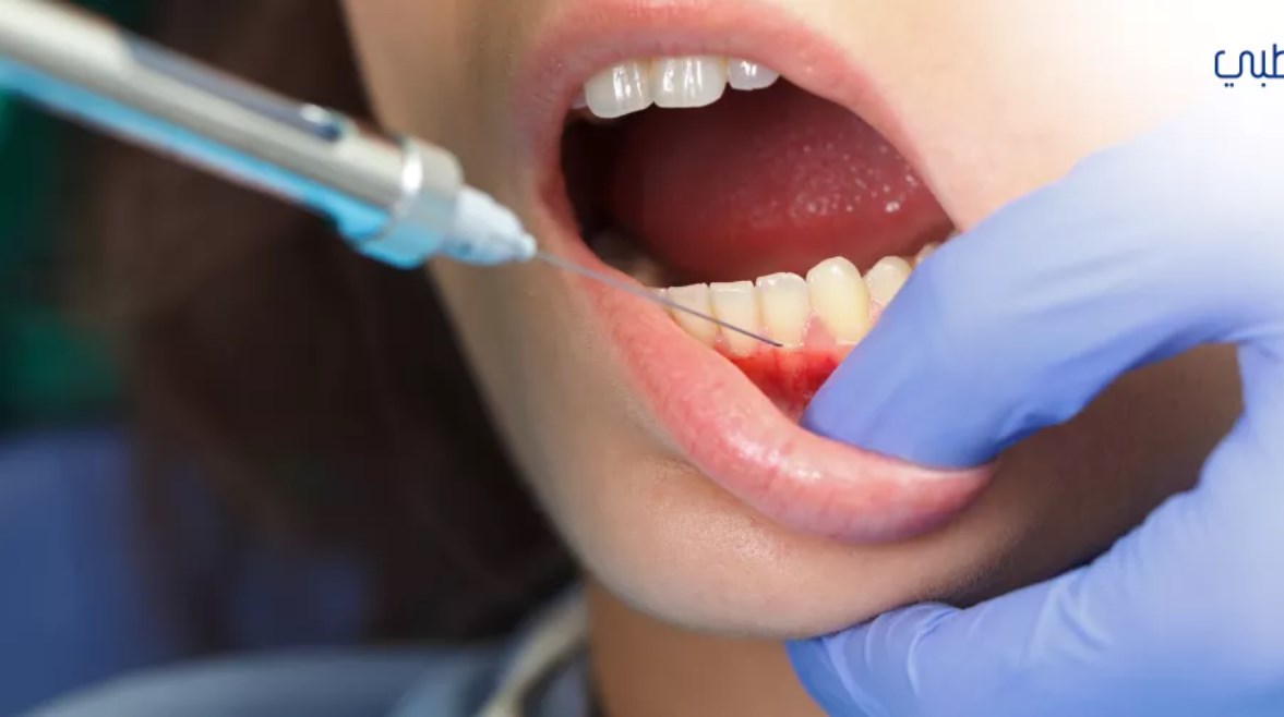 بنج الأسنان