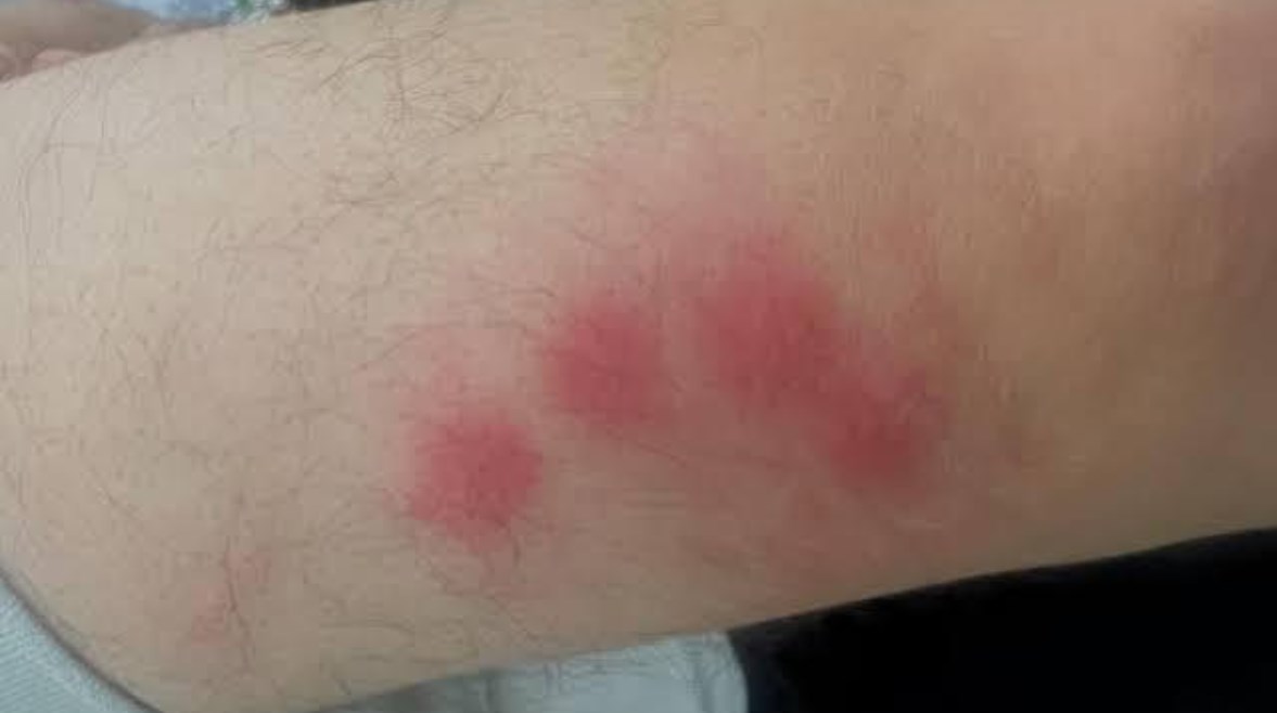 أثر لدغات حشرة البق على أجساد التلاميذ