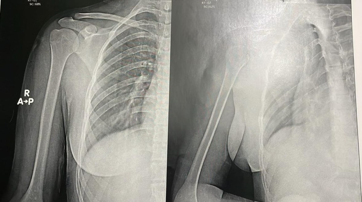 الأشعة الطبية للفتاة