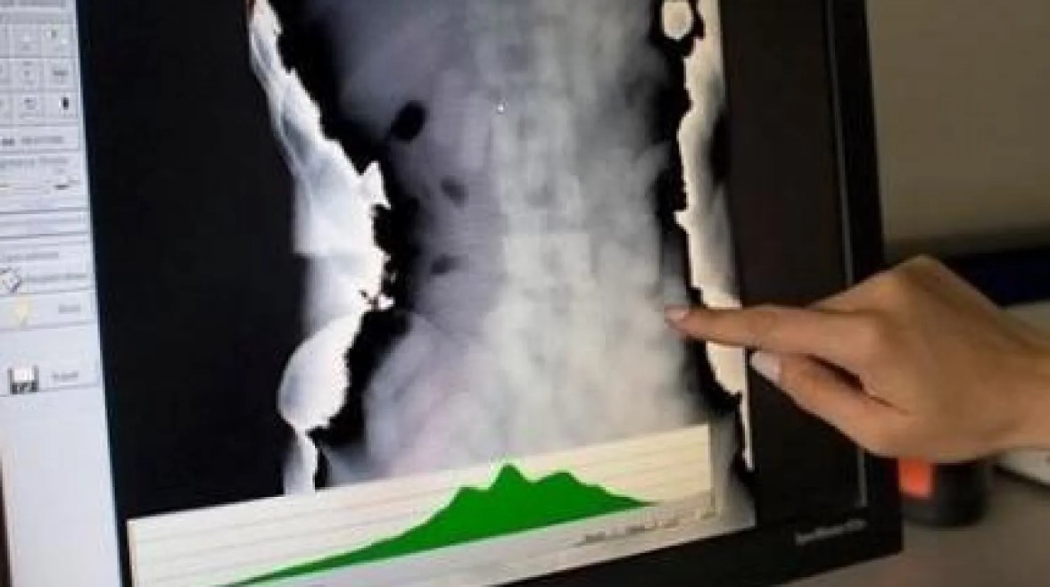 الكوكايين داخل أمعاء أحد المهربين في مطار فرانكفورت 2017