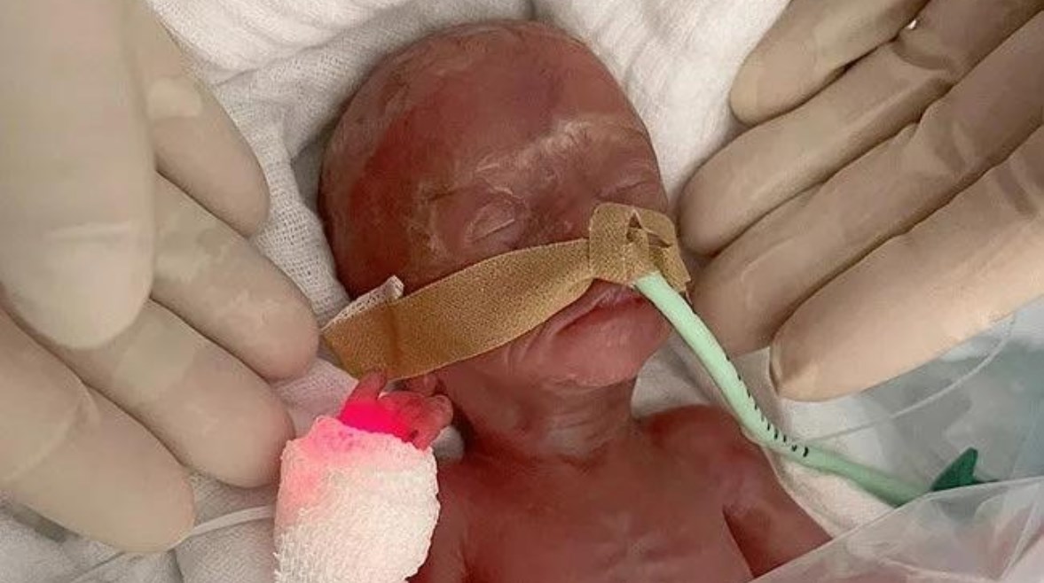 نجاة طفلة بعد ولادة مبكرة