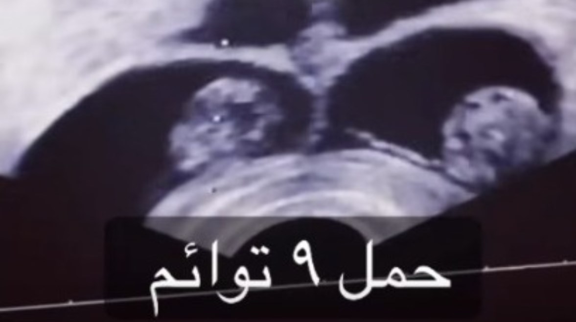 الموجات الفوق صوتية لسيدة حامل بـ 9 أجنة