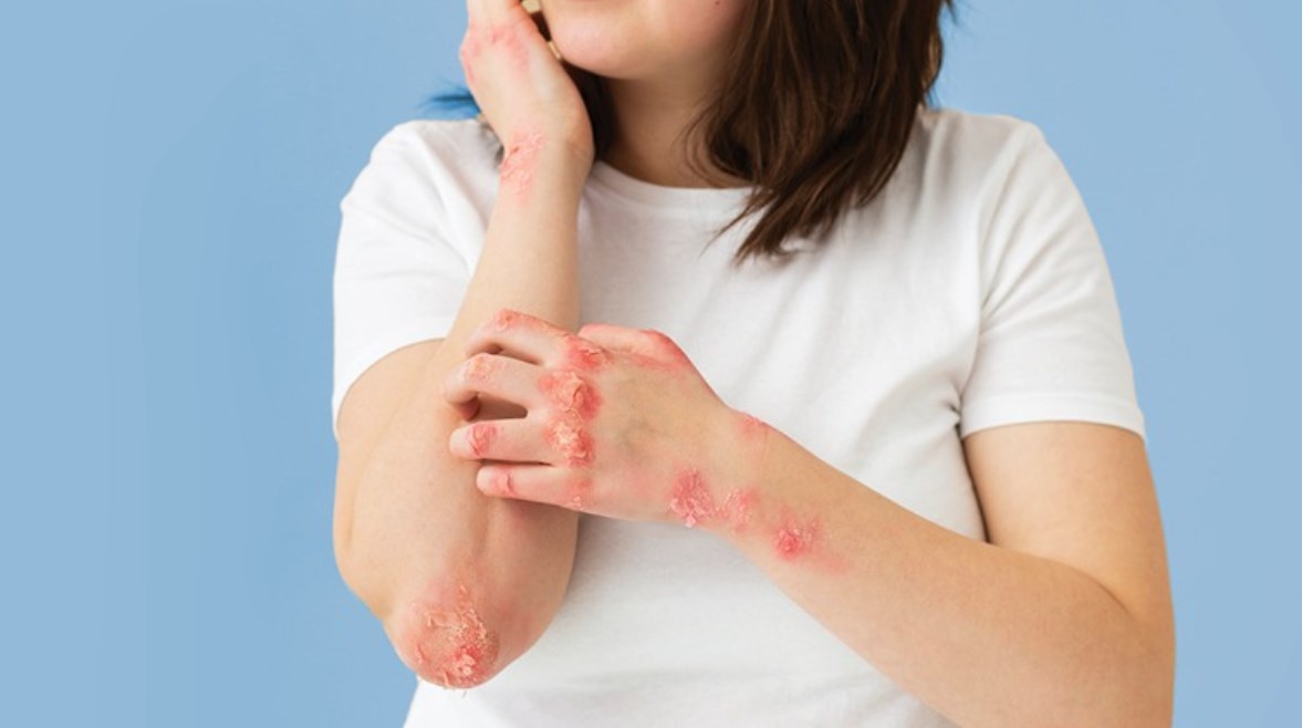 كيف يؤثر الشتاء على حاجز جلد مرضى الأكزيما والصدفية؟