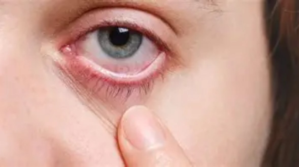 مرض  التراكوما 