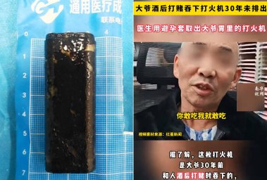 الرجل الصيني والولاعة التي استخرجوها من معدته