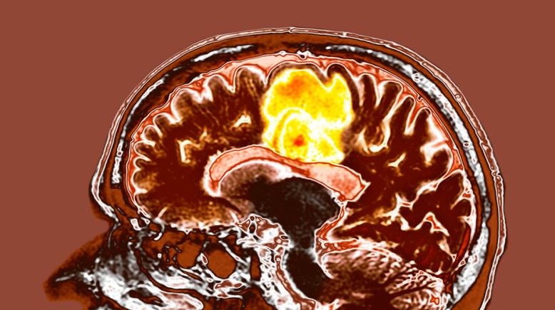 الورم الأرومي 