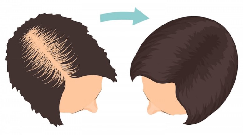 زراعة الشعر لدى النساء- تعبيرية