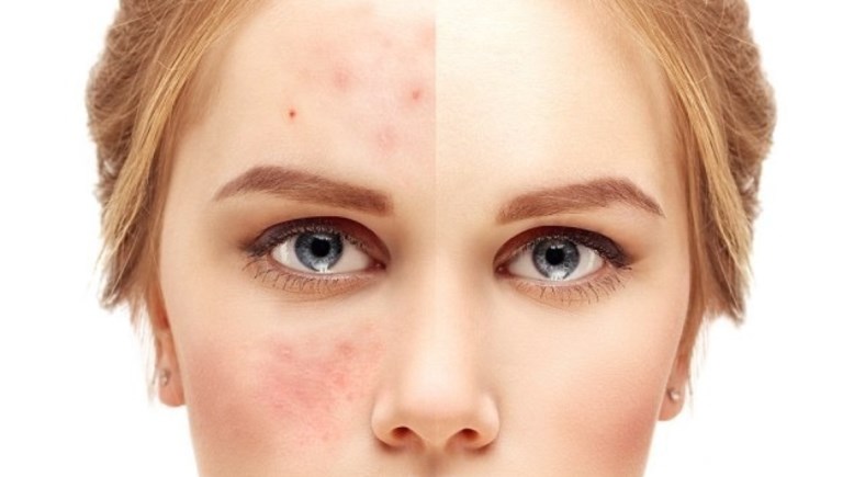 ترميم حاجز البشرة في الشتاء