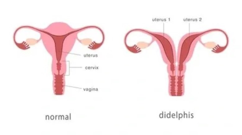 الفرق بين الرحم الطبيعي والمزدوج