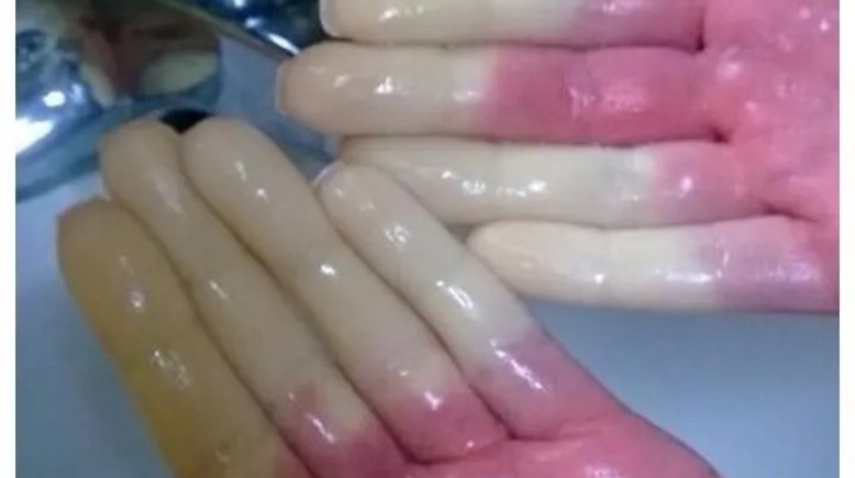 ظاهرة رينود 