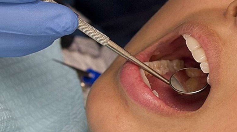 التهاب اللثة-تعبيرية